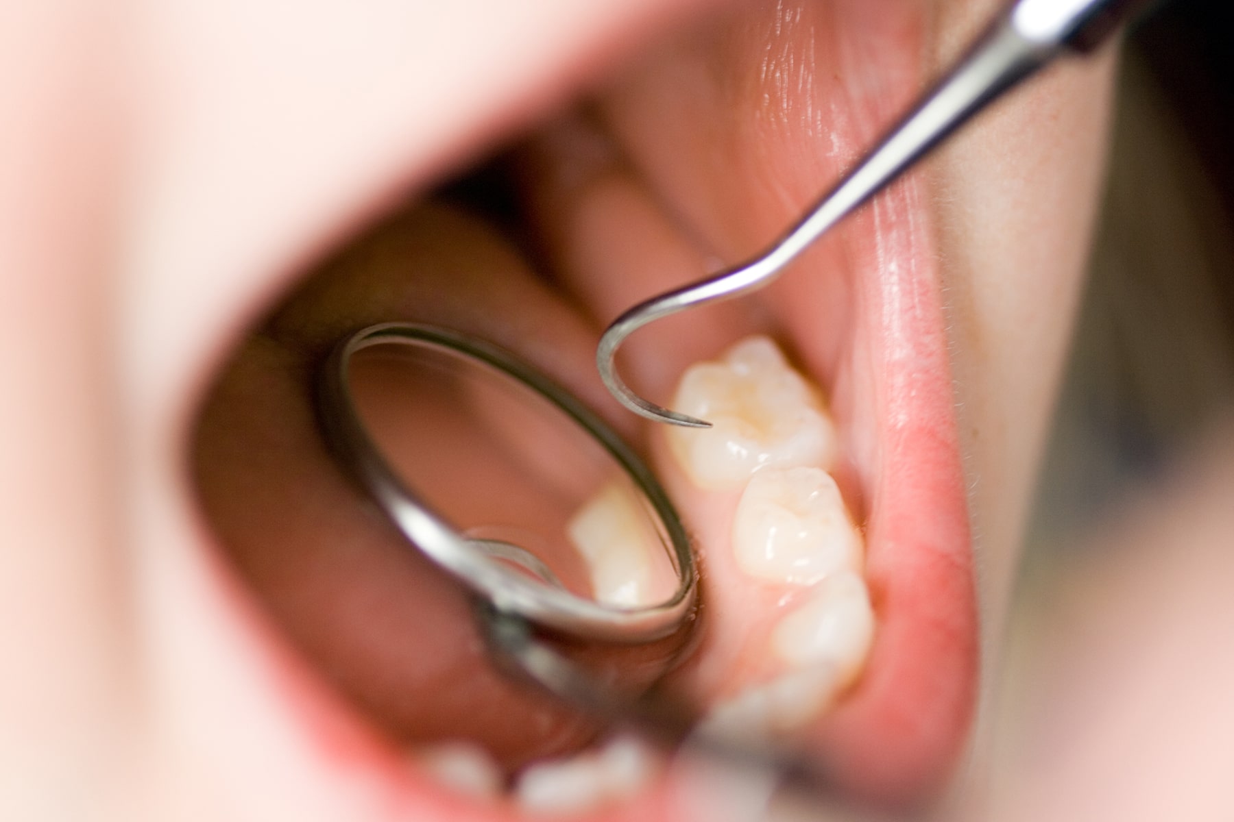 Cavity filllings in Cincinnati, OH